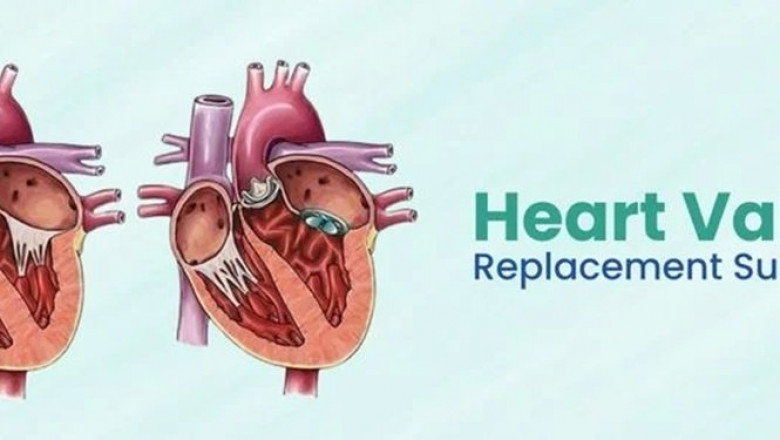 How to Navigate the Cost of Heart Valve Replacement Surgery in India
