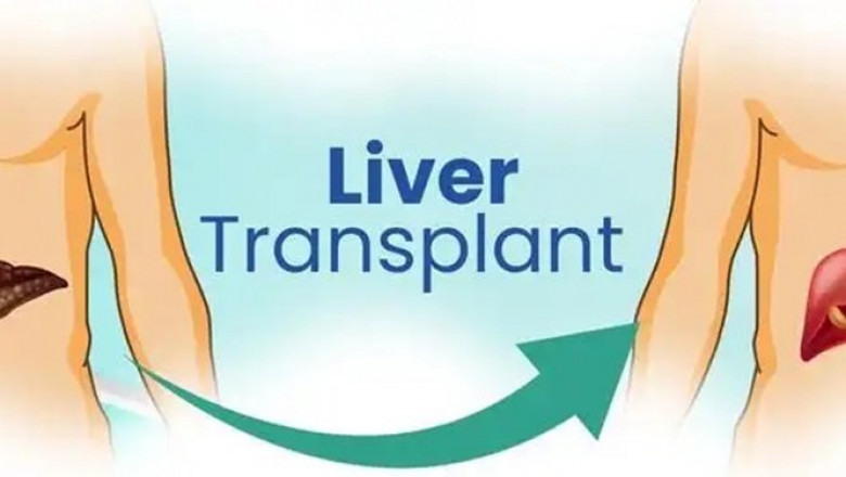 Liver Transplant Cost in India – What You Need to Know