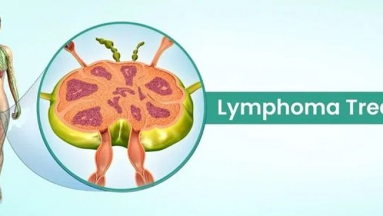 Lymphoma Treatment Cost in India – A Comprehensive Guide