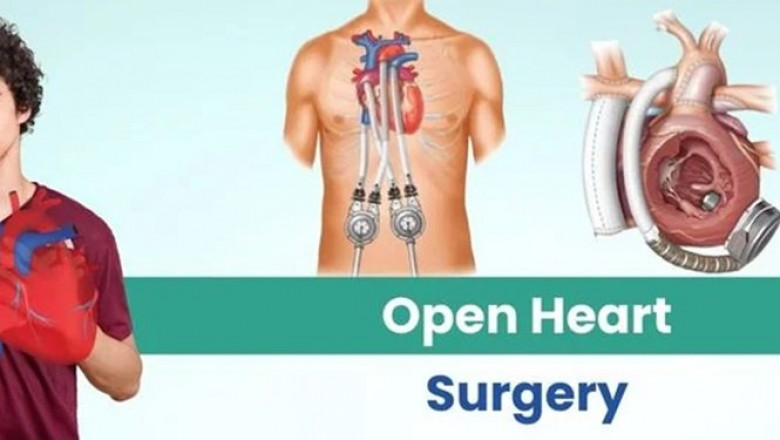 Understanding Open Heart Surgery