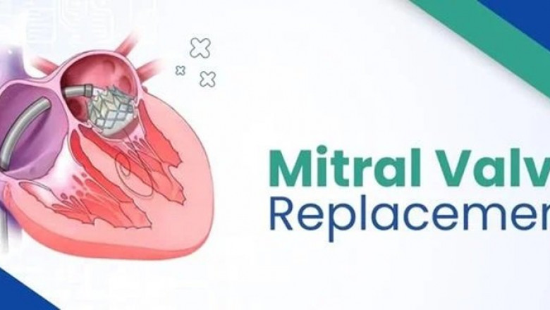 Why You Should Consider Mitral Valve Replacement Surgery in India for Quality Heart Care