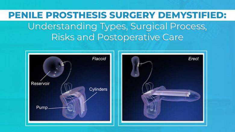 Penile Prosthesis Surgery | Worldofurology