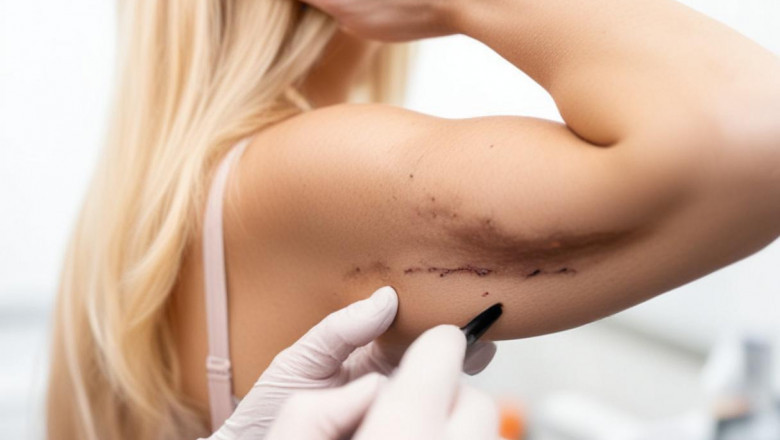 A Traveler’s Guide to Brachioplasty in Istanbul – Experience Surgery and Culture with Lifeline Turkey