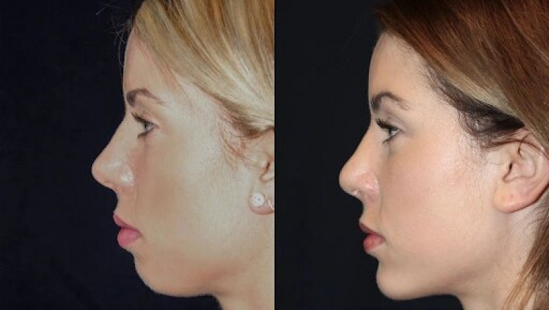Best Aesthetic Clinics in dubai for Chin Fillers and Jawline Sculpting