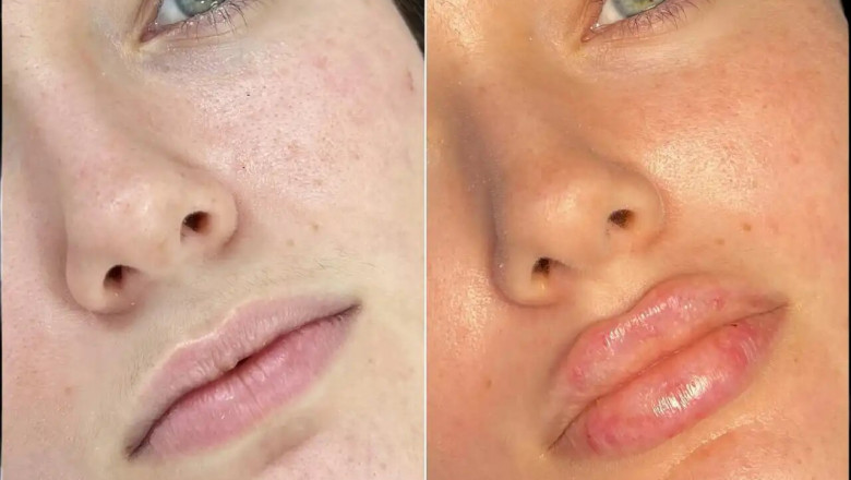 Best Aesthetic Clinics in dubai for Fillers: The Non-Surgical Alternative to Facelifts