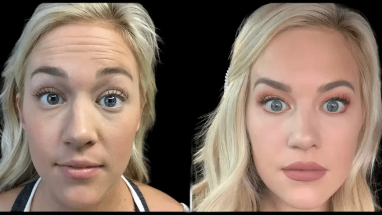 How Long Does Botox Last? Insights from the Best Aesthetic Clinics in dubai