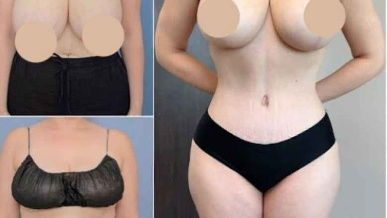 How to Achieve Your Body Goals with Body Contouring in Dubai