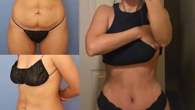 How Tummy Tuck in Dubai Can Help with Excess Skin After Weight Loss