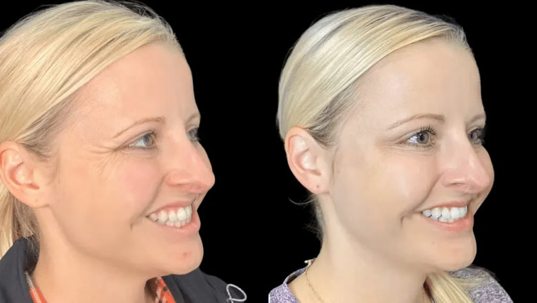 Real Client Transformations from the Best Aesthetic Clinic in Dubai