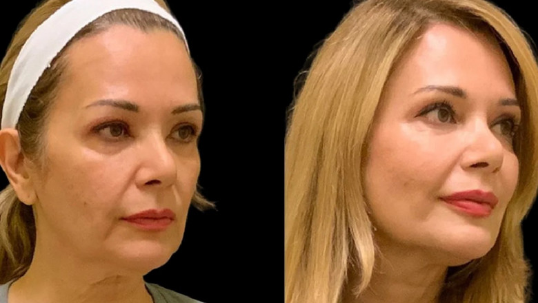 Cheek Fillers in Dubai: How to Get the Best Results