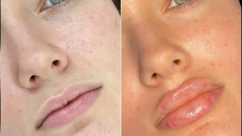 Aesthetic Excellence: Best Plastic Surgeon in Dubai for Fillers