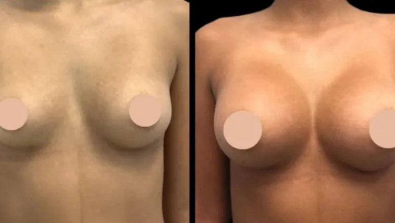 Exploring Minimally Invasive Options for Breast Augmentation with the Best Doctors in Dubai