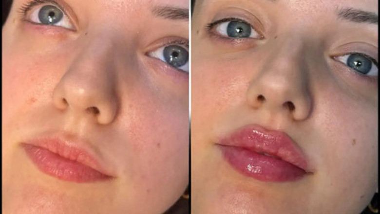 The Best Fillers Treatments in Dubai for Smoothing Wrinkles and Fine Lines