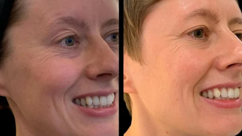 How Profhilo Can Rejuvenate Your Skin Insights from the Best Doctors in Dubai