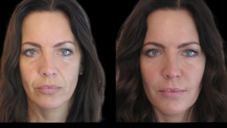 Best Plastic Surgeons in dubai for Jawline Fillers: Pricing and Quality Guide