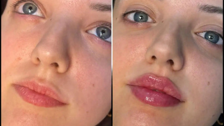 Choosing the Best Plastic Surgeons in dubai for Fillers Injections