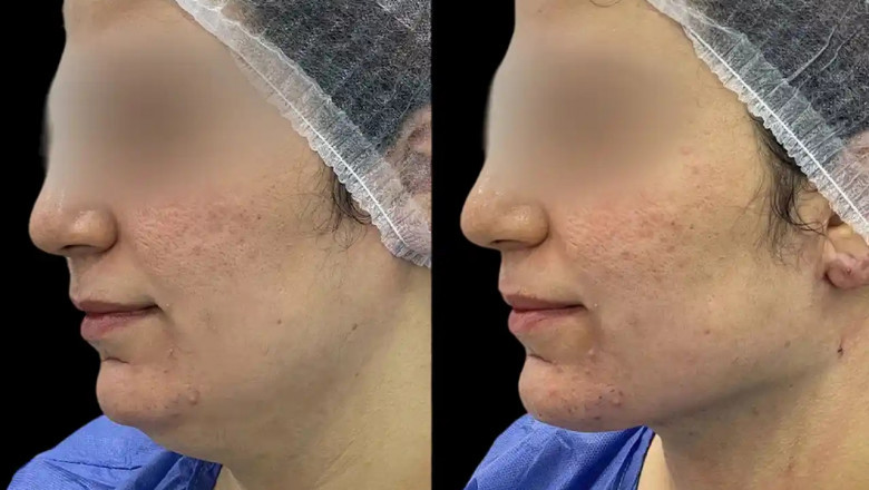 Long-Term Chin Fillers Care Tips from the Best Plastic Surgeons in dubai